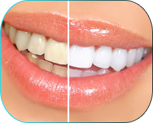 Teeth Whitening Promotions